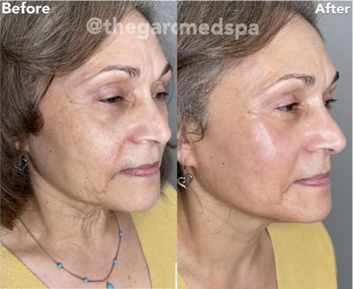 Before & After triLift™ Facial Rejuvenation Client #2 Right Side View in Tampa Bay, North Palm Beach, FL