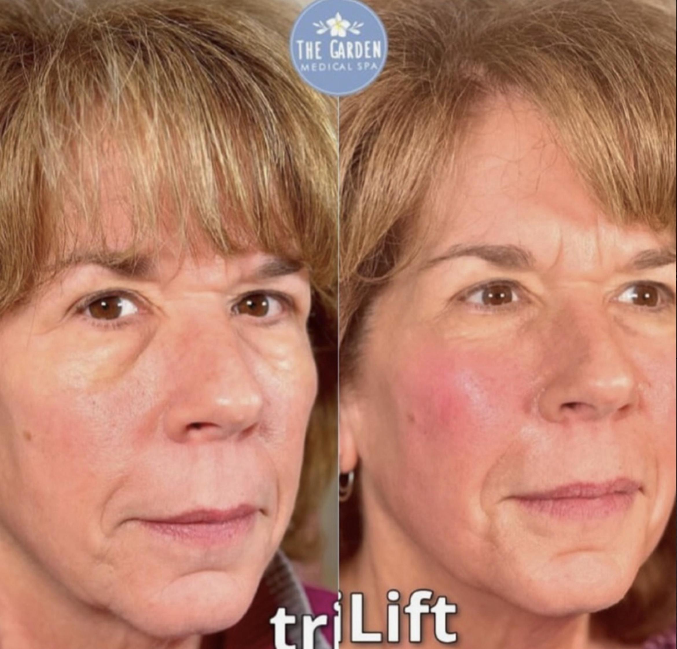 Trilift for Volume Loss