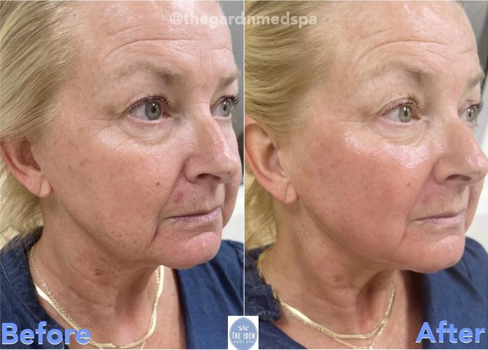 Before & After triLift™ Facial Rejuvenation Client #3 Right Side View in Tampa Bay, North Palm Beach, FL