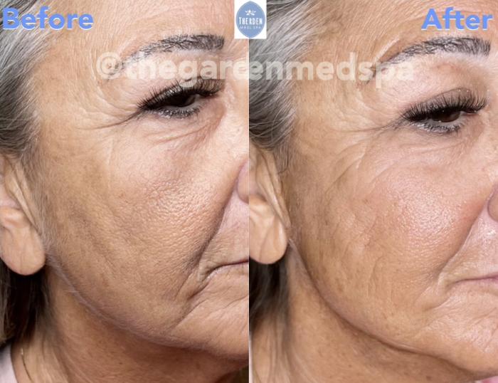 Before & After triLift™ Facial Rejuvenation Client #4 Right Side View in Tampa Bay, North Palm Beach, FL