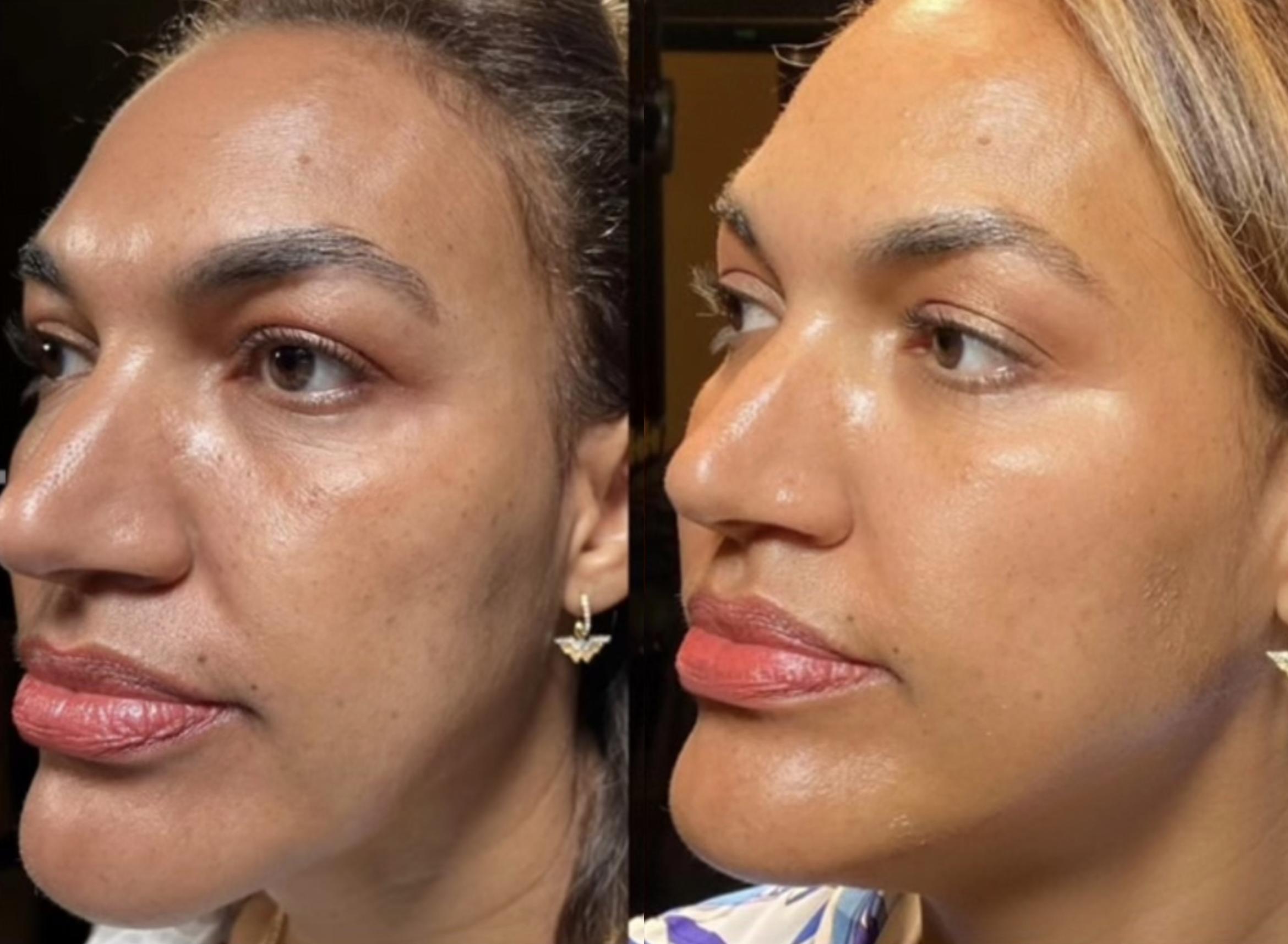 Before & After triLift™ Facial Rejuvenation Client #5 Left Side View in Tampa Bay, North Palm Beach, FL