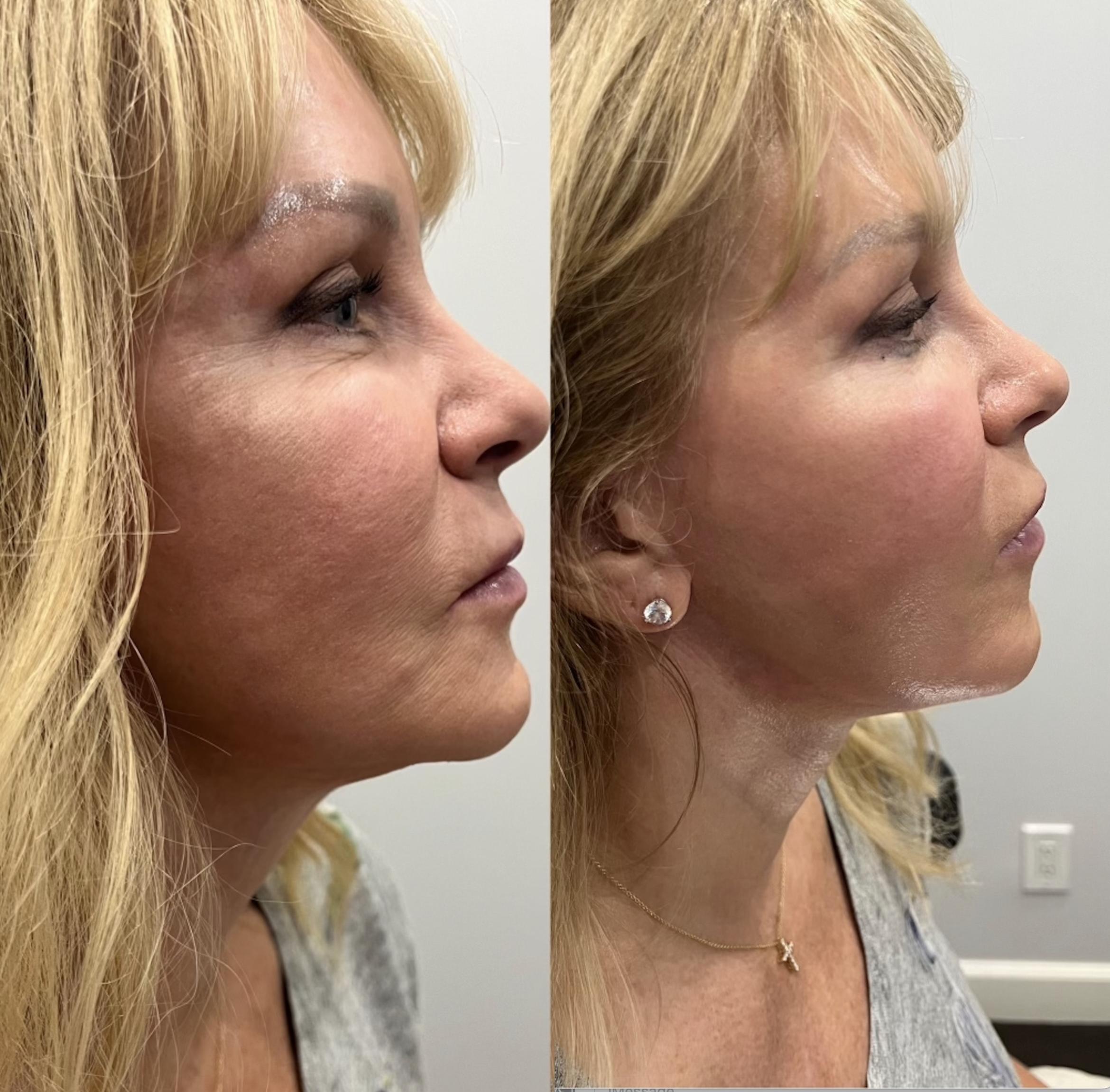 Before & After triLift™ Facial Rejuvenation Client #69 Right Side View in Tampa Bay, North Palm Beach, FL