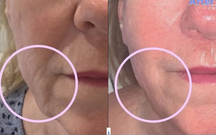 Before & After triLift™ Facial Rejuvenation Client #84 Front View in Tampa Bay, North Palm Beach, FL