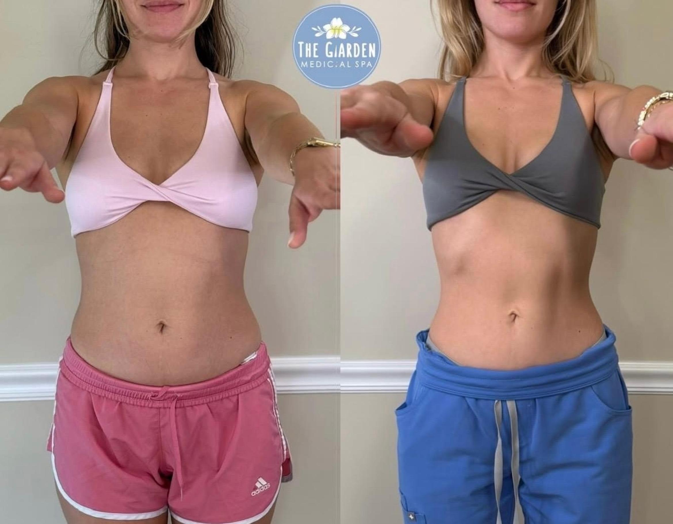 Before & After Weight Loss Client #168 Front View in Pinellas Park, Clearwater, St. Petersburg, North Palm Beach